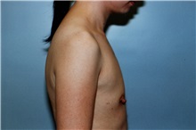 Breast Augmentation Before Photo by Kristoffer Ning Chang, MD; San Francisco, CA - Case 23164