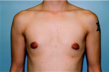 Male Breast Reduction After Photo by Kristoffer Ning Chang, MD; San Francisco, CA - Case 23253