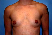 Male Breast Reduction Before Photo by Kristoffer Ning Chang, MD; San Francisco, CA - Case 23253