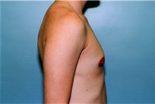 Male Breast Reduction After Photo by Kristoffer Ning Chang, MD; San Francisco, CA - Case 23253