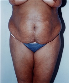 Tummy Tuck Before Photo by Kristoffer Ning Chang, MD; San Francisco, CA - Case 23286