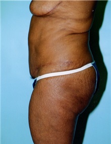 Tummy Tuck After Photo by Kristoffer Ning Chang, MD; San Francisco, CA - Case 23286
