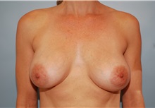 Breast Augmentation After Photo by Kristoffer Ning Chang, MD; San Francisco, CA - Case 23489