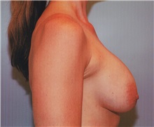 Breast Augmentation Before Photo by Kristoffer Ning Chang, MD; San Francisco, CA - Case 23489