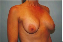Breast Augmentation Before Photo by Kristoffer Ning Chang, MD; San Francisco, CA - Case 23489