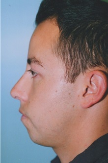 Rhinoplasty After Photo by Kristoffer Ning Chang, MD; San Francisco, CA - Case 24004
