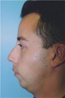 Rhinoplasty Before Photo by Kristoffer Ning Chang, MD; San Francisco, CA - Case 24004