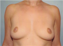 Breast Augmentation Before Photo by Kristoffer Ning Chang, MD; San Francisco, CA - Case 24302