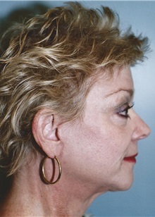 Facelift After Photo by Kristoffer Ning Chang, MD; San Francisco, CA - Case 24693