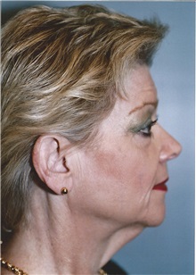 Facelift Before Photo by Kristoffer Ning Chang, MD; San Francisco, CA - Case 24693