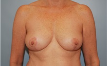 Breast Reduction After Photo by Kristoffer Ning Chang, MD; San Francisco, CA - Case 24710