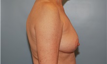 Breast Reduction After Photo by Kristoffer Ning Chang, MD; San Francisco, CA - Case 24710