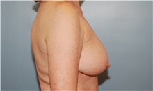Breast Reduction Before Photo by Kristoffer Ning Chang, MD; San Francisco, CA - Case 24710