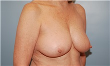 Breast Reduction Before Photo by Kristoffer Ning Chang, MD; San Francisco, CA - Case 24710