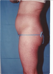 Liposuction Before Photo by Kristoffer Ning Chang, MD; San Francisco, CA - Case 28330