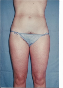 Liposuction After Photo by Kristoffer Ning Chang, MD; San Francisco, CA - Case 28331