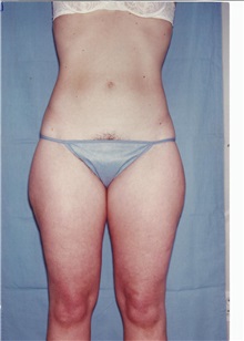 Liposuction Before Photo by Kristoffer Ning Chang, MD; San Francisco, CA - Case 28331