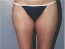 Liposuction Before Photo by Kristoffer Ning Chang, MD; San Francisco, CA - Case 28349