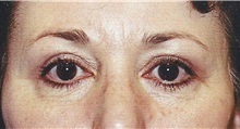 Eyelid Surgery After Photo by Kristoffer Ning Chang, MD; San Francisco, CA - Case 28741