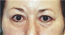 Eyelid Surgery Before Photo by Kristoffer Ning Chang, MD; San Francisco, CA - Case 28741