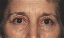 Eyelid Surgery Before Photo by Kristoffer Ning Chang, MD; San Francisco, CA - Case 28744