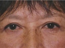 Eyelid Surgery After Photo by Kristoffer Ning Chang, MD; San Francisco, CA - Case 28754