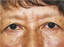 Eyelid Surgery Before Photo by Kristoffer Ning Chang, MD; San Francisco, CA - Case 28754