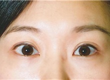 Eyelid Surgery After Photo by Kristoffer Ning Chang, MD; San Francisco, CA - Case 28755