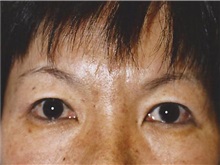 Eyelid Surgery After Photo by Kristoffer Ning Chang, MD; San Francisco, CA - Case 28757