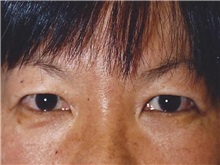 Eyelid Surgery Before Photo by Kristoffer Ning Chang, MD; San Francisco, CA - Case 28757