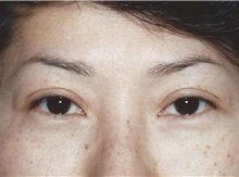 Eyelid Surgery After Photo by Kristoffer Ning Chang, MD; San Francisco, CA - Case 28758