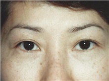 Eyelid Surgery Before Photo by Kristoffer Ning Chang, MD; San Francisco, CA - Case 28758