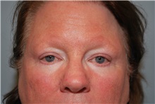 Eyelid Surgery After Photo by Kristoffer Ning Chang, MD; San Francisco, CA - Case 29766
