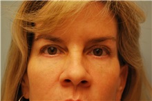 Eyelid Surgery After Photo by Kristoffer Ning Chang, MD; San Francisco, CA - Case 29768