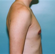 Breast Reduction After Photo by Kristoffer Ning Chang, MD; San Francisco, CA - Case 29809