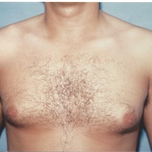 Breast Reduction Before Photo by Kristoffer Ning Chang, MD; San Francisco, CA - Case 29811