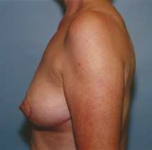 Breast Lift After Photo by Kristoffer Ning Chang, MD; San Francisco, CA - Case 29894