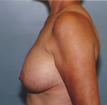 Breast Lift Before Photo by Kristoffer Ning Chang, MD; San Francisco, CA - Case 29894