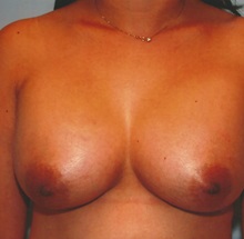 Breast Augmentation After Photo by Kristoffer Ning Chang, MD; San Francisco, CA - Case 29897