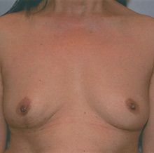 Breast Reconstruction After Photo by Kristoffer Ning Chang, MD; San Francisco, CA - Case 29898