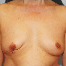 Breast Reconstruction Before Photo by Kristoffer Ning Chang, MD; San Francisco, CA - Case 29898