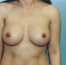Breast Augmentation After Photo by Kristoffer Ning Chang, MD; San Francisco, CA - Case 29900