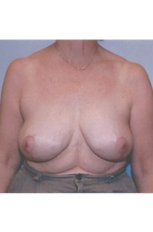 Breast Lift After Photo by Kristoffer Ning Chang, MD; San Francisco, CA - Case 29906