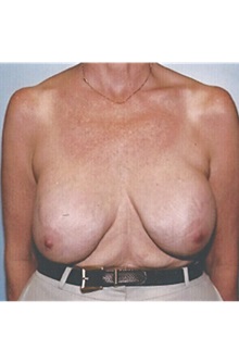 Breast Lift Before Photo by Kristoffer Ning Chang, MD; San Francisco, CA - Case 29906