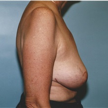 Breast Lift After Photo by Kristoffer Ning Chang, MD; San Francisco, CA - Case 29906