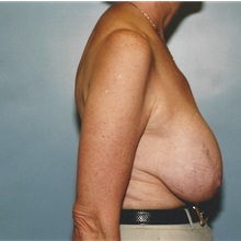 Breast Lift Before Photo by Kristoffer Ning Chang, MD; San Francisco, CA - Case 29906