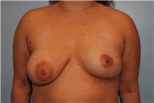 Breast Augmentation After Photo by Kristoffer Ning Chang, MD; San Francisco, CA - Case 30807