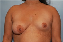 Breast Augmentation Before Photo by Kristoffer Ning Chang, MD; San Francisco, CA - Case 30807