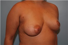 Breast Augmentation After Photo by Kristoffer Ning Chang, MD; San Francisco, CA - Case 30807