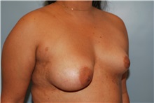 Breast Augmentation Before Photo by Kristoffer Ning Chang, MD; San Francisco, CA - Case 30807